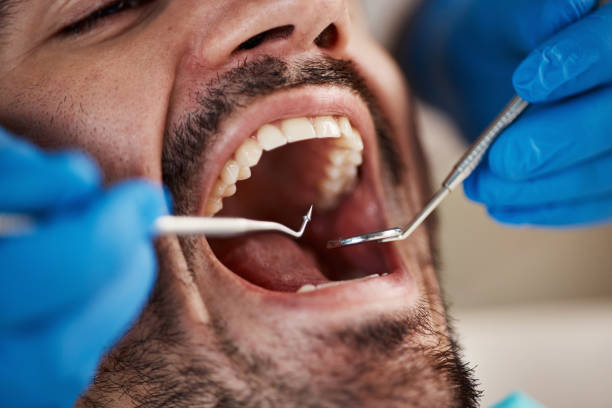Best Wisdom Tooth Removal  in Clyde Hill, WA